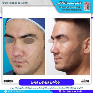 جراحی-بینی-132