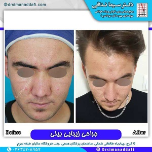 جراحی-بینی-133