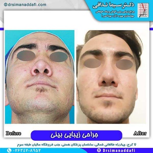 جراحی-بینی-134