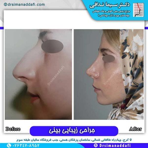 جراحی-بینی-135