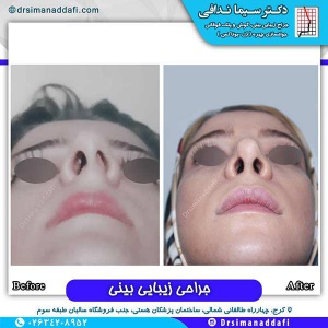جراحی-بینی-136