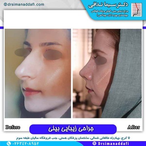 جراحی-بینی-138