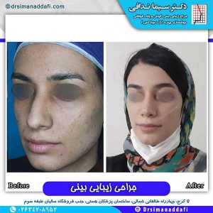 جراحی-بینی-139