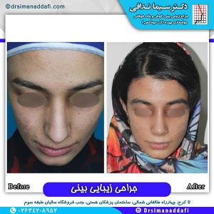 جراحی-بینی-140