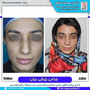 جراحی-بینی-141