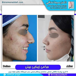 جراحی-بینی-142
