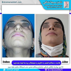جراحی-بینی-143