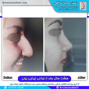 جراحی-بینی-145