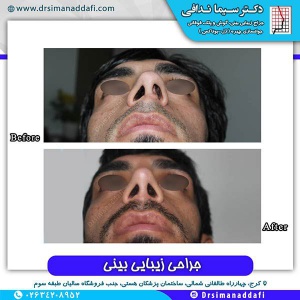 جراحی-بینی-146