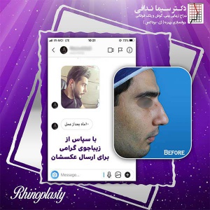 جراحی-بینی-148