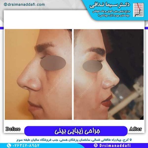 جراحی-بینی-149