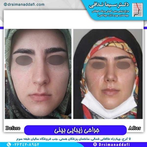 جراحی-بینی-150