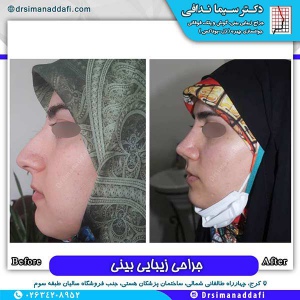 جراحی-بینی-151