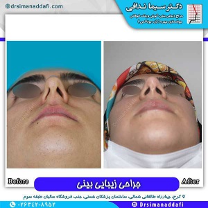 جراحی-بینی-152