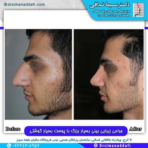 جراحی-بینی-153