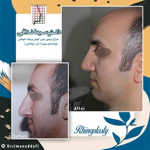 جراحی-بینی-155