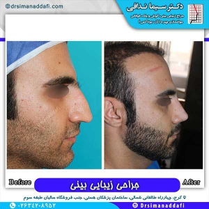 جراحی-بینی-163