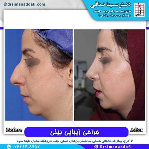 جراحی-بینی-165