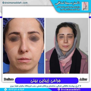 جراحی-بینی-166