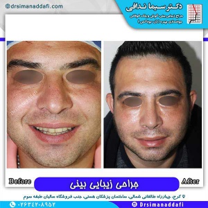 جراحی-بینی-168