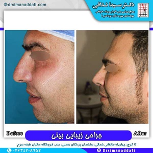 جراحی-بینی-169