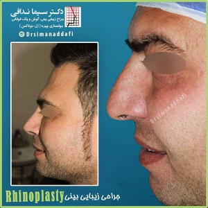جراحی-بینی-170