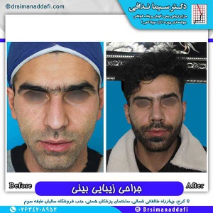 جراحی-بینی-171