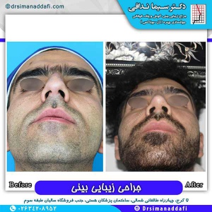جراحی-بینی-172