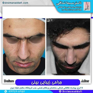 جراحی-بینی-173