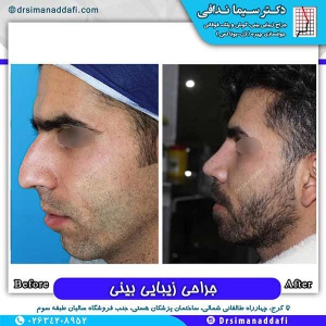 جراحی-بینی-174