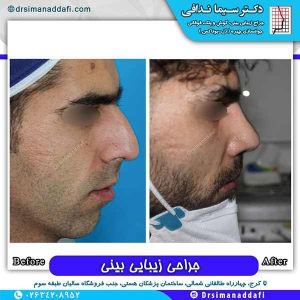 جراحی-بینی-175