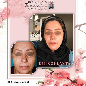 جراحی-بینی-176
