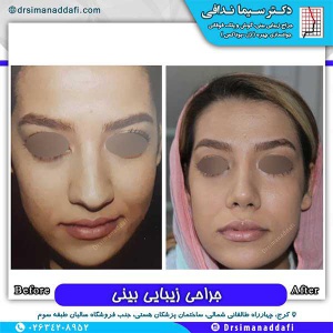جراحی-بینی-178