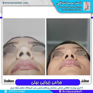 جراحی-بینی-179