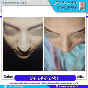 جراحی-بینی-180