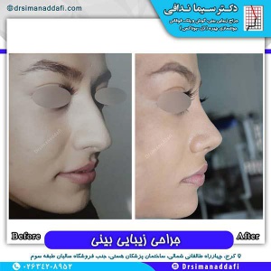 جراحی-بینی-181
