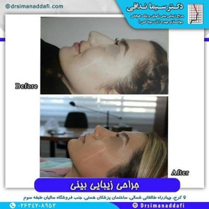 جراحی-بینی-182