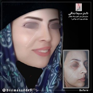 جراحی-بینی-183