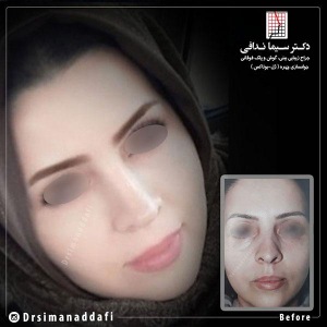 جراحی-بینی-184
