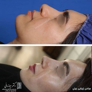 جراحی-بینی-196