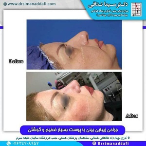 جراحی-بینی-199