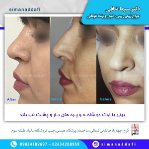 جراحی-بینی-2