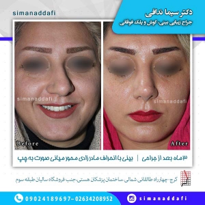 جراحی-بینی-20