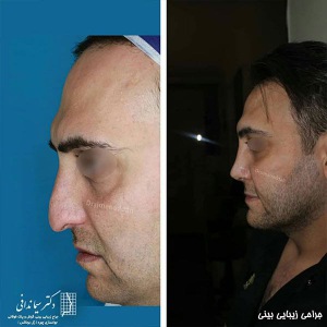 جراحی-بینی-204