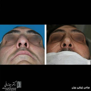 جراحی-بینی-206