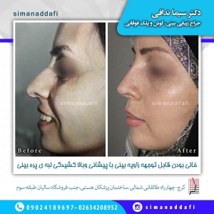 جراحی-بینی-21