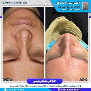 جراحی-بینی-213