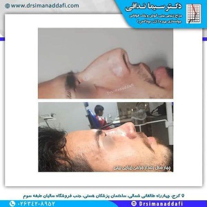 جراحی-بینی-214