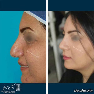 جراحی-بینی-217