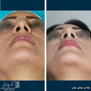 جراحی-بینی-218